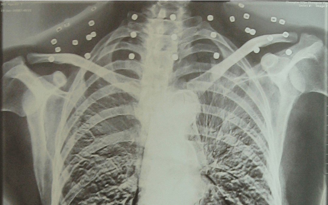 皇冠信用怎么弄_“老先生皇冠信用怎么弄，您把项链取下来再做CT”“你看是不是弹片”